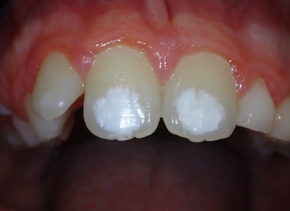 Close-up of adult front teeth showing white chalky patches on enamel, a common sign of enamel demineralisation.