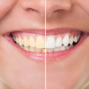 Intrinsic and Extrinsic teeth whitening UK